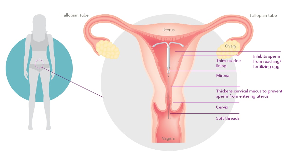 Close-up view of what Mirena® may look like in the body